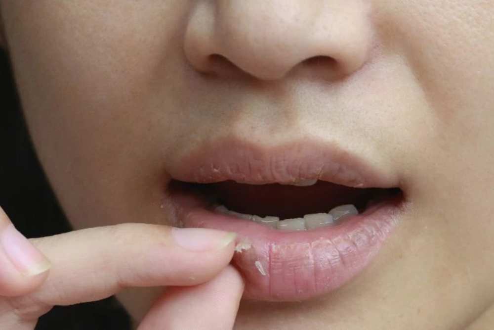 5 Penyebab Bibir Kering dan Gelap yang Harus Diketahui!