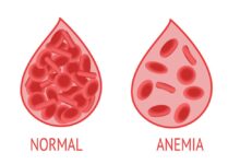 30% Remaja Putri Cirebon Alami Anemia, Kenali Pemicunya!