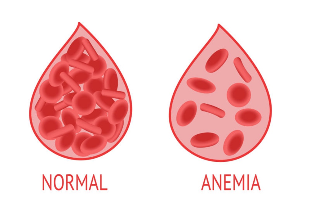 30% Remaja Putri Cirebon Alami Anemia, Kenali Pemicunya!