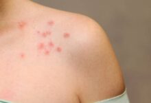 7 Fakta Penting Herpes Zoster: Risiko, Pencegahan, dan Fakta Menarik