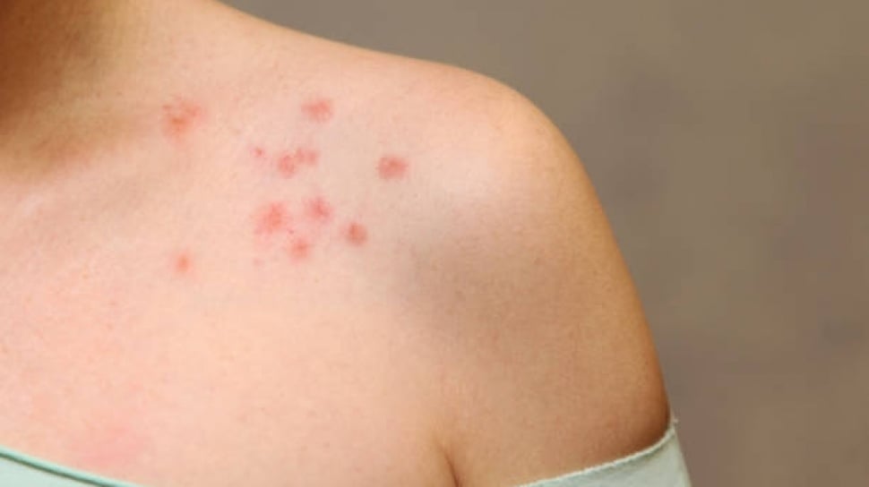 7 Fakta Penting Herpes Zoster: Risiko, Pencegahan, dan Fakta Menarik