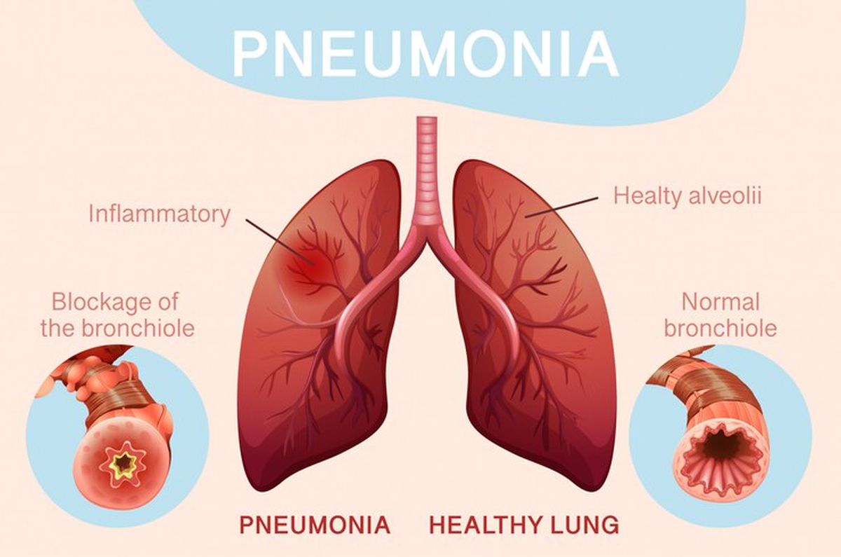 Tragedi Pneumonia: Barbie Hsu Meninggal, Fenita Arie Masuk RS